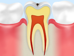 CO：歯の表面のむし歯