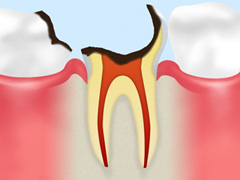 C4：歯根に達したむし歯
