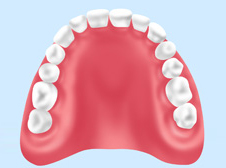 レジン床義歯