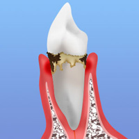 歯周病の進行